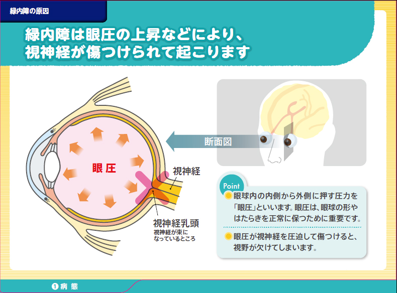 緑内障は眼圧の上昇などにより、視神経が傷つけられて起こります